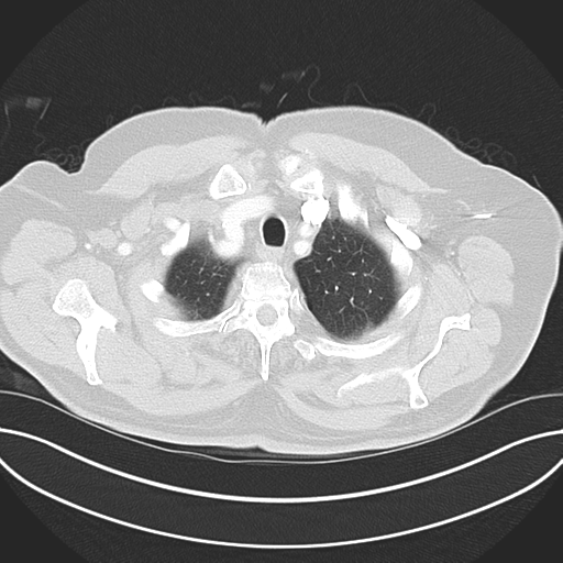 Adenocarcioma of rectum- T1 lesion (Radiopaedia 36921-38547 Axial lung window 11).png