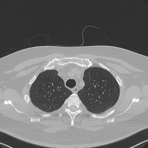 File:Adenoid cystic carcinoma of the trachea (Radiopaedia 49042-54137 Axial lung window 70).jpg