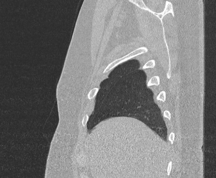 Adenoid cystic carcinoma of the trachea (Radiopaedia 49042-54137 Sagittal lung window 60).jpg