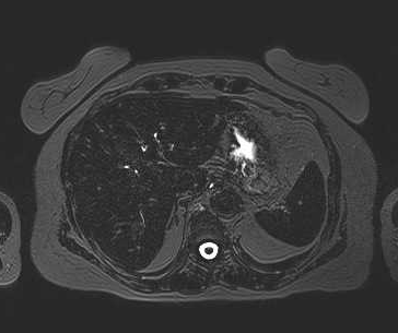 File:Adenomyomatosis of the gallbladder (Radiopaedia 50246-55587 Axial 94).png