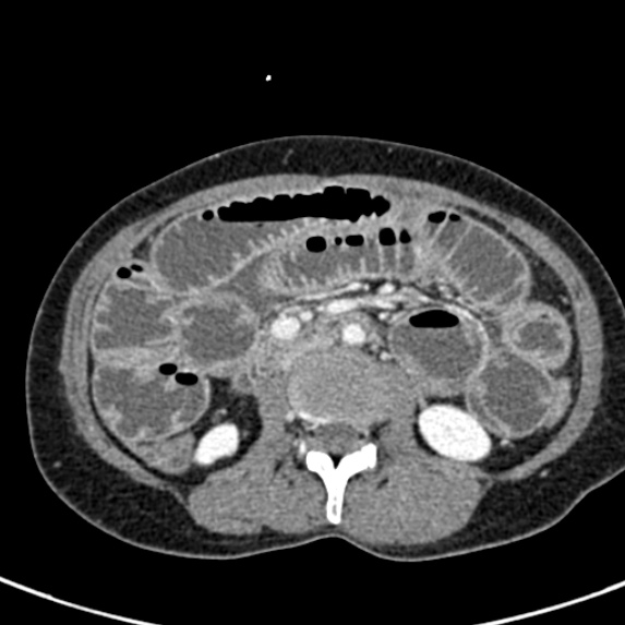 File:Adhesional small bowel obstruction (Radiopaedia 48397-53305 Axial C+ portal venous phase 38).jpg