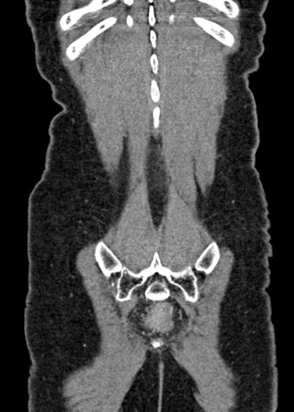 Adhesional small bowel obstruction (Radiopaedia 48397-53305 Coronal C+ portal venous phase 319).jpg