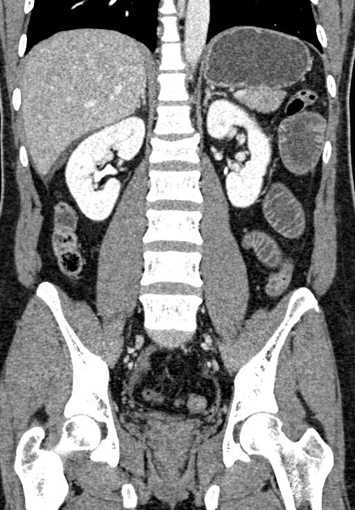 Adhesional small bowel obstruction (Radiopaedia 58900-66131 Coronal C+ portal venous phase 165).jpg