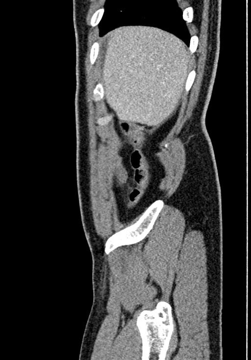 Adhesional small bowel obstruction (Radiopaedia 58900-66131 Sagittal C+ portal venous phase 30).jpg