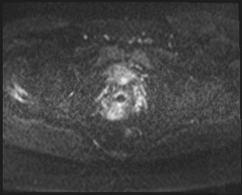Adnexal multilocular cyst (O-RADS US 3- O-RADS MRI 3) (Radiopaedia 87426-103754 Axial DWI 50).jpg