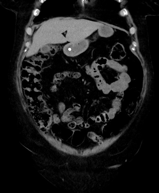 Adrenal cortical carcinoma (Radiopaedia 64017-72769 Coronal C+ delayed 19).jpg