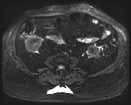 Adrenal cortical carcinoma (Radiopaedia 64017-72770 Axial DWI 36).jpg