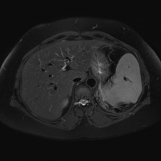 File:Adrenal cortical carcinoma (Radiopaedia 70906-81116 Axial T2 fat sat 13).jpg