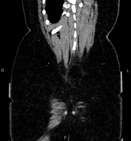 Adrenal cortical carcinoma (Radiopaedia 84882-100379 Coronal C+ portal venous phase 62).jpg
