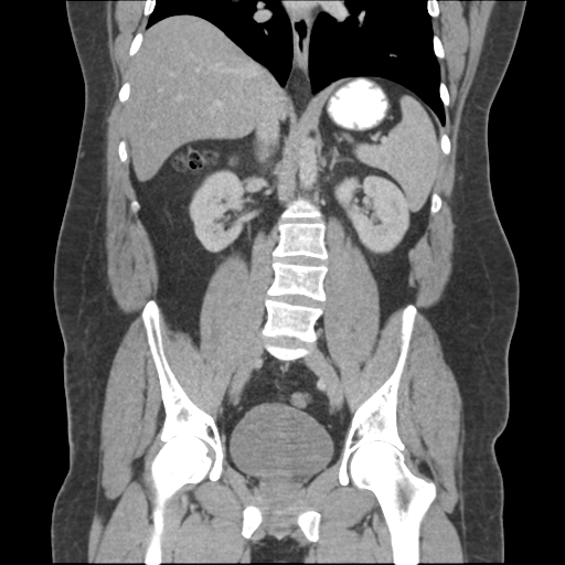 Adrenal cyst (Radiopaedia 45625-49776 Coronal C+ portal venous phase 44).png