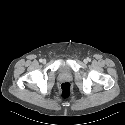 Adrenal cyst (Radiopaedia 45625-49777 Axial C+ portal venous phase 100).png