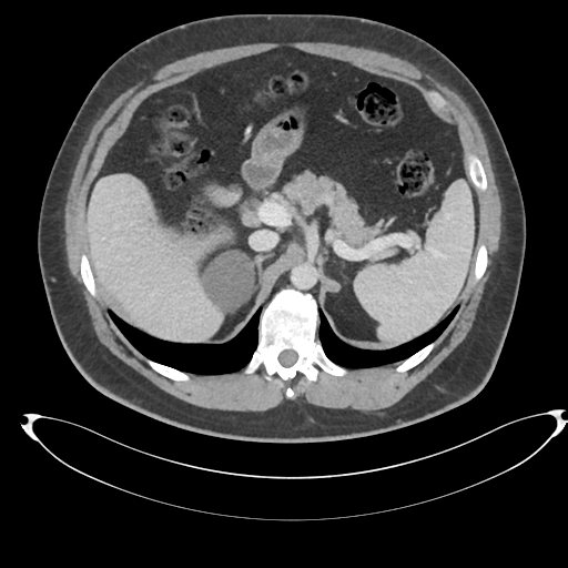 File:Adrenal cyst (Radiopaedia 45625-49778 AXIAL THICK 60 sec 17).png