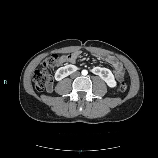 Adrenal cystic lymphangioma (Radiopaedia 83161-97534 Axial C+ arterial phase 54).jpg