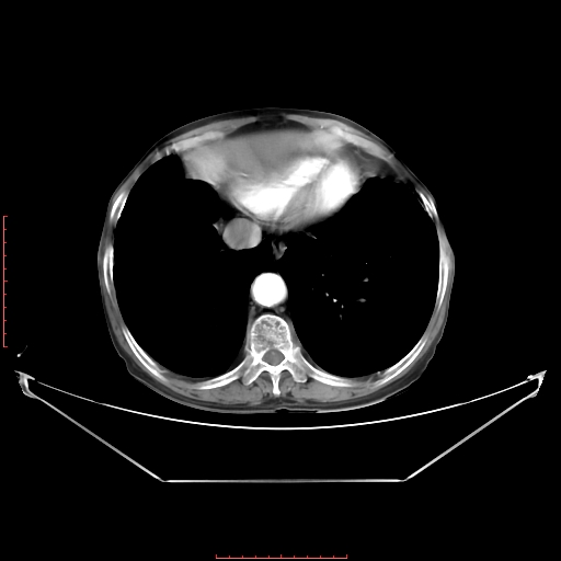 Adrenal hemangioma (Radiopaedia 68923-78668 Axial C+ arterial phase 14).jpg