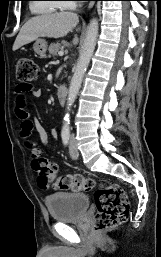 Adrenal lymphoma (Radiopaedia 73730-84529 Sagittal C+ portal venous phase 57).jpg