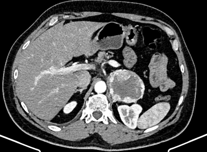Adrenal metastases (Radiopaedia 73082-83791 Axial C+ arterial phase 47).jpg