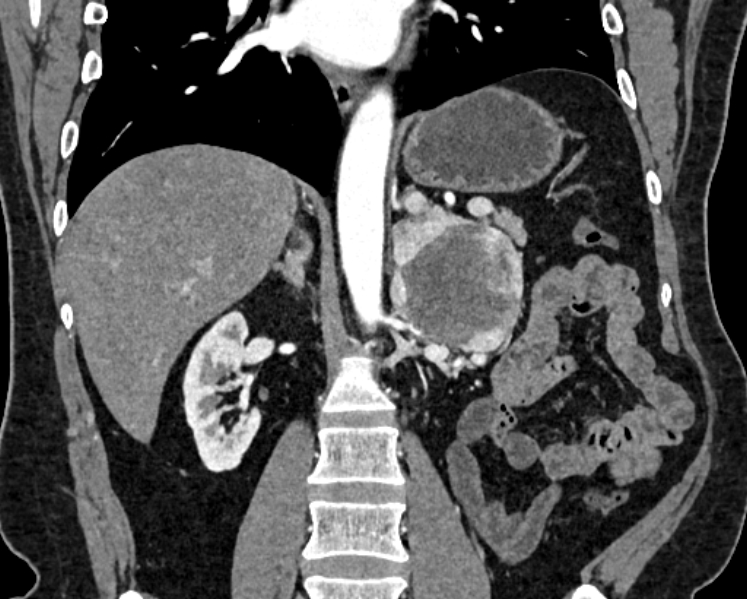 Adrenal metastases (Radiopaedia 73082-83791 Coronal C+ arterial phase 35).jpg