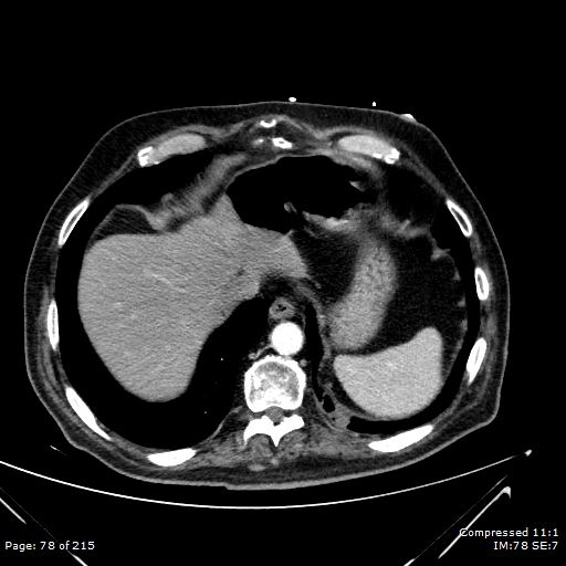 File:Adrenal metastasis (Radiopaedia 78425-91079 Axial C+ arterial phase 8).jpg