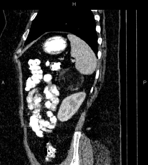 Adrenal myelolipoma (Radiopaedia 84319-99617 Sagittal renal cortical phase 78).jpg