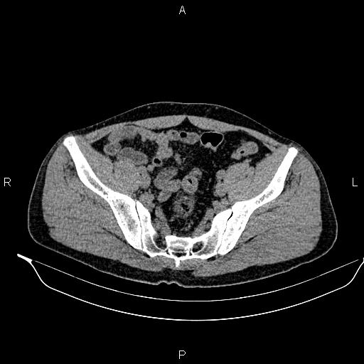 Adrenal myelolipoma (Radiopaedia 87794-104246 Axial non-contrast 86).jpg