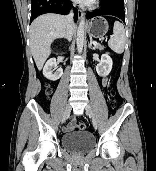 Adrenal myelolipoma (Radiopaedia 87794-104246 Coronal renal cortical phase 36).jpg
