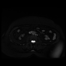 File:Adrenal myelolipoma - MRI (Radiopaedia 83249-97646 Axial STIR 28).jpg
