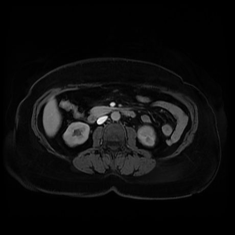 Adrenal myelolipoma - MRI (Radiopaedia 83249-97646 T1 fat sat arterial phase 55).jpg