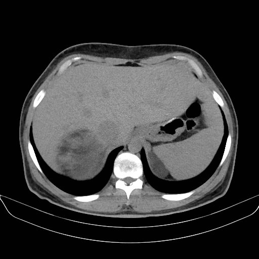 Adrenal myelolipoma - bilateral (Radiopaedia 74805-85810 Axial non-contrast 13).jpg