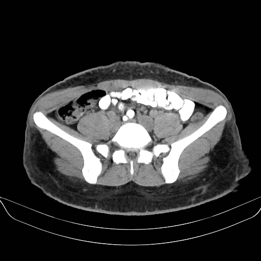 Adrenal myelolipoma - bilateral (Radiopaedia 74805-85810 Axial non-contrast 56).jpg