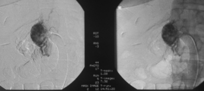 File:Adrenal remnant after nephrectomy (Radiopaedia 15936-15586 C 1).jpg