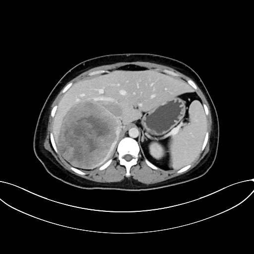 Adrenocortical carcinoma (Radiopaedia 87281-103569 Axial C+ portal venous phase 24).jpg