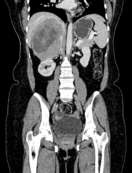 Adrenocortical carcinoma (Radiopaedia 87281-103569 Coronal C+ portal venous phase 65).jpg