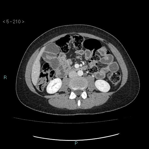 Adult transient intestinal intussusception (Radiopaedia 34853-36310 Axial C+ portal venous phase 40).jpg