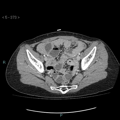 File:Adult transient intestinal intussusception (Radiopaedia 34853-36310 Axial C+ portal venous phase 95).jpg