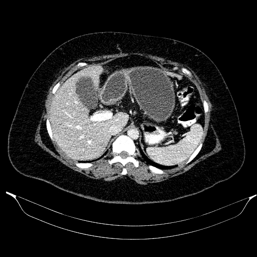 File:Afferent loop syndrome - secondary to incarcerated trocar site hernia (Radiopaedia 82959-97305 Axial C+ portal venous phase 60).jpg