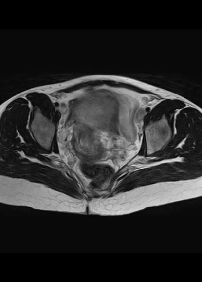 File:Aggressive angiomyxoma of the pelvis and perineum (Radiopaedia 59162-66479 Axial T2 11).jpg