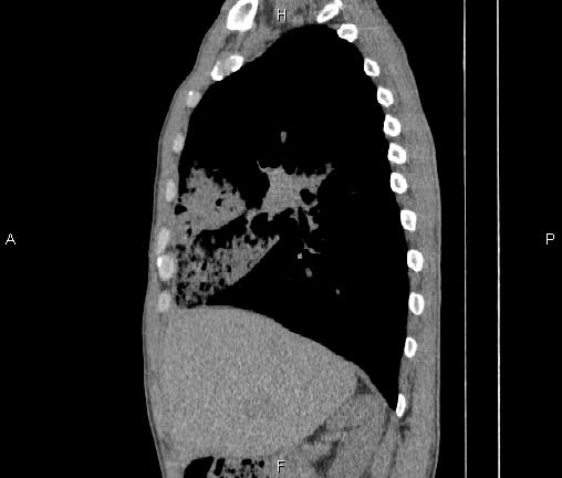 File:Air bronchogram in pneumonia (Radiopaedia 85719-101512 F 33).jpg