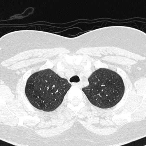 File:Air trapping in small airway disease (Radiopaedia 61685-69694 Axial lung window 31).jpg