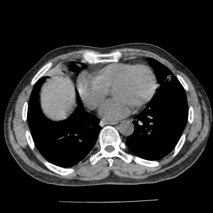 Airway foreign body in adult (Radiopaedia 85907-101779 Axial liver window 125).jpg