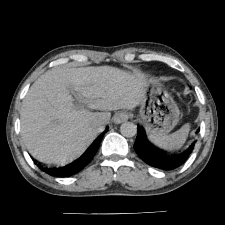Airway foreign body in adult (Radiopaedia 85907-101779 Axial liver window 180).jpg