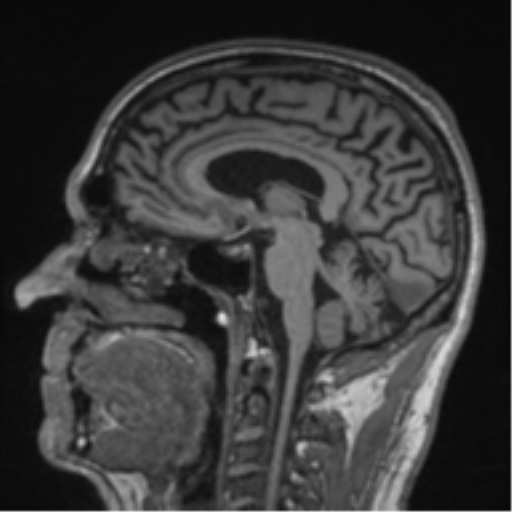 File:Alzheimer's disease- with Gerstmann syndrome and dressing apraxia (Radiopaedia 54882-61150 Sagittal T1 38).png