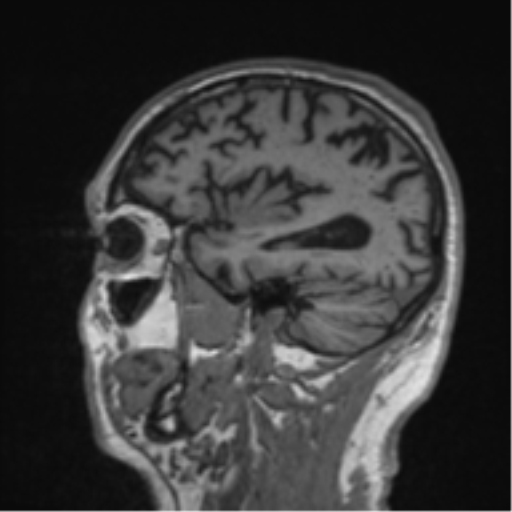 Alzheimer's disease- with Gerstmann syndrome and dressing apraxia (Radiopaedia 54882-61150 Sagittal T1 54).png