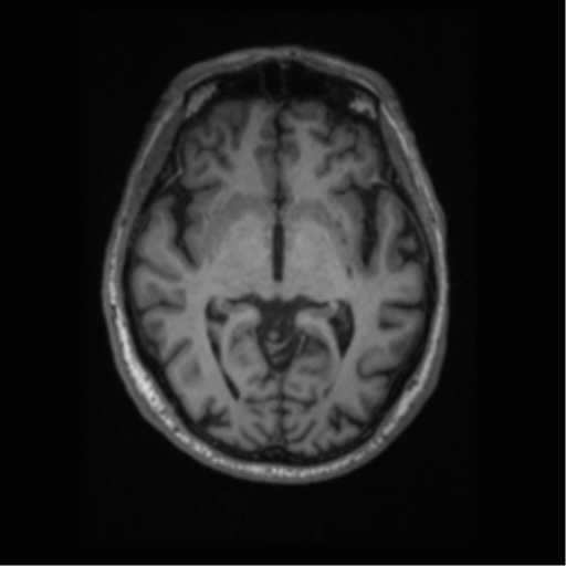 Alzheimer disease - probable (Radiopaedia 35334-36837 Axial T1 37).png