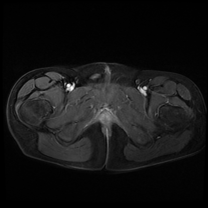 Ambiguous genitalia (Radiopaedia 69686-79643 Axial T1 C+ fat sat 48).jpg