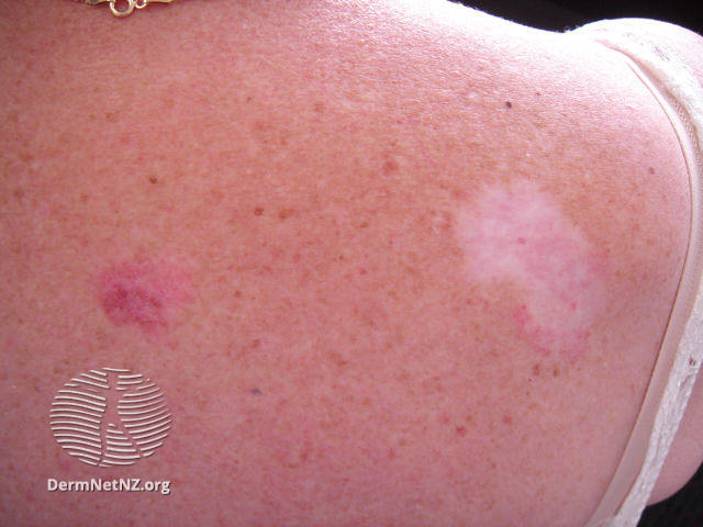 File:Amelanotic melanoma on left (DermNet NZ amelanotic-melanoma-clinical3).jpg