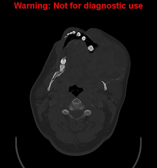 Ameloblastoma (Radiopaedia 33126-34164 Axial bone window 13).jpg