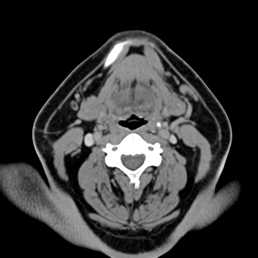 Ameloblastoma (Radiopaedia 38520-40623 Axial non-contrast 39).png