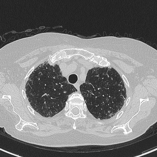 Amiodarone-induced pulmonary fibrosis (Radiopaedia 82355-96460 Axial lung window 15).jpg