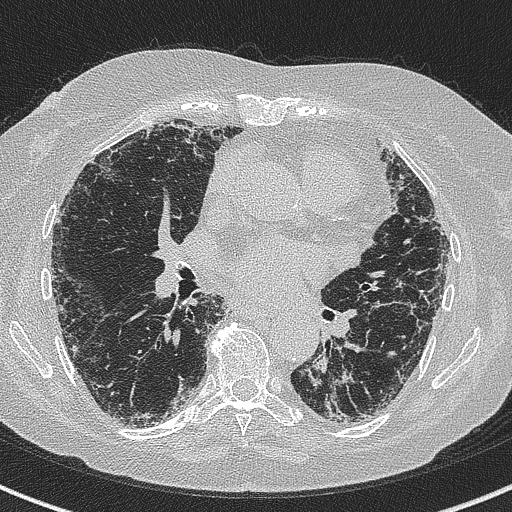 Amiodarone-induced pulmonary fibrosis (Radiopaedia 82355-96460 Axial lung window 37).jpg