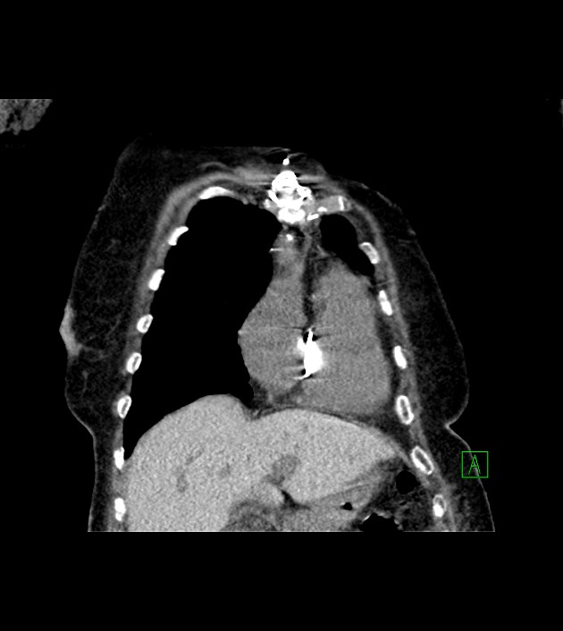 Amiodarone deposition in the liver (Radiopaedia 77587-89780 Coronal non-contrast 22).jpg